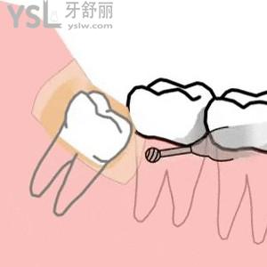 國(guó)產(chǎn)氧化鋯全瓷牙冠價(jià)格，氧化鋯全瓷牙和二氧化鋯全瓷牙有什么區(qū)別？