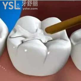 登士柏樹脂補(bǔ)牙