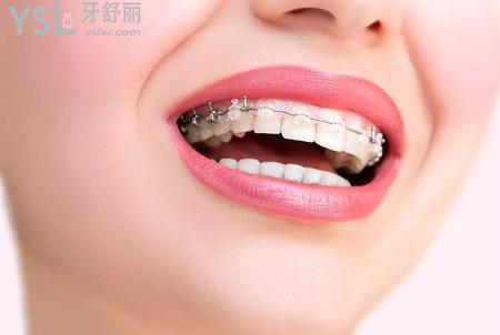 牙齒矯正后遺癥和危害有哪些？