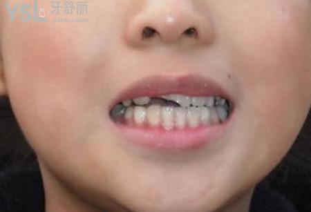 牙齒斷了能用樹脂補牙嗎？