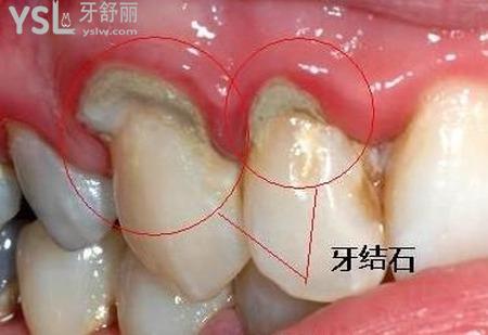 洗牙一次多少錢？時間長嗎？