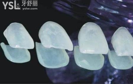 烤瓷牙貼面能使用多久？