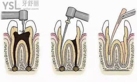 根管治療要多少錢？