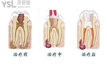 根管治療有什么注意事項(xiàng)？