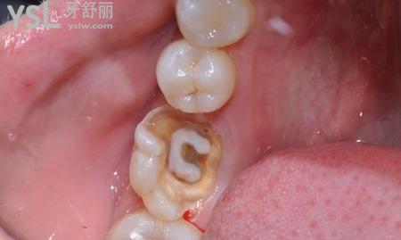 根管治療是怎么回事？