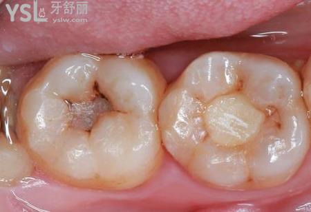 根管治療的危害有哪些？