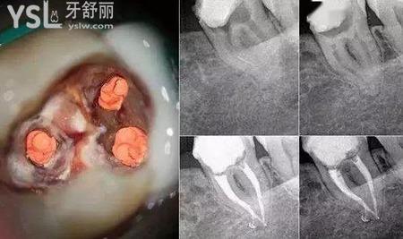 根管治療能用多少年？