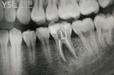一次根管治療要幾小時(shí)？