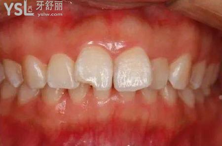牙周治療怎么治療？