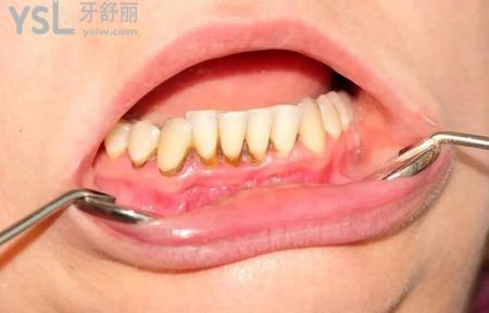 什么樣的牙需要牙周手術(shù)治療。
