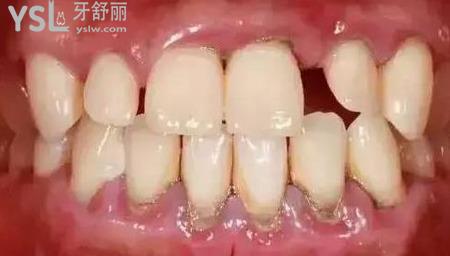 什么叫牙周刮治？