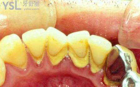 牙周刮治有什么副作用？
