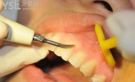 牙齒根周炎是怎么引起的？