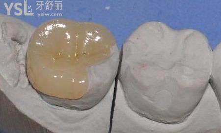 嵌體好還是烤瓷牙好？