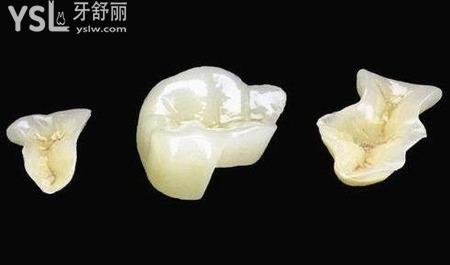 什么是“蛀牙”？得了蛀牙怎么辦？