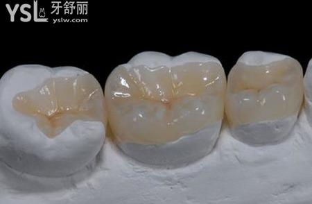 嵌體使用的注意事項(xiàng)有什么？