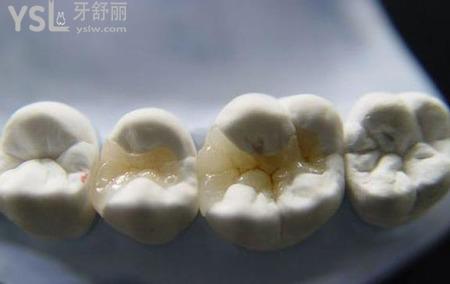 嵌體和全冠哪個(gè)好？