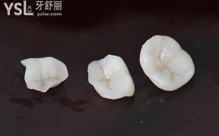 嵌體為什么老是掉？