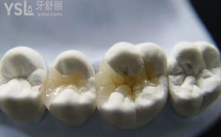 嵌體的優(yōu)缺點是哪些？
