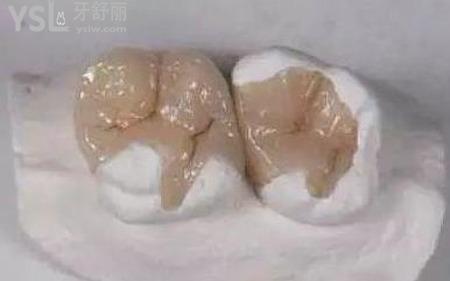 嵌體和牙套哪個好？