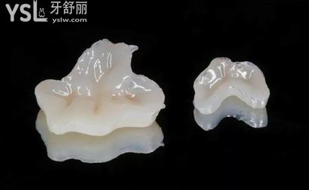 什么是牙體缺損的嵌體修復？