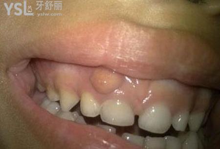 牙上面起個膿包怎么辦？