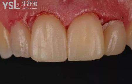 什么是全瓷貼面修復？
