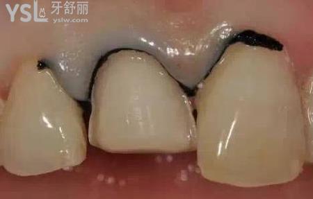 瓷貼面容易掉嗎？