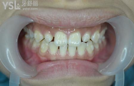 什么癥狀比較適合做瓷貼面？