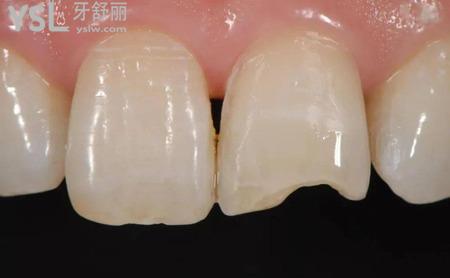 瓷貼面修復有哪些優(yōu)勢？