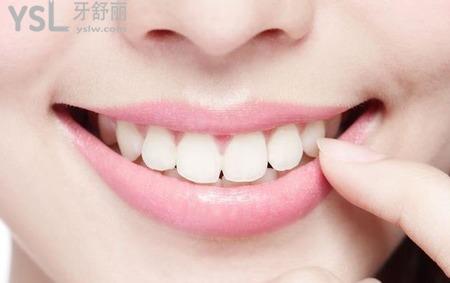瓷貼面后該怎么自我維護和保養(yǎng)？