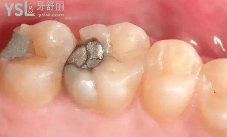 有必要補牙嗎？