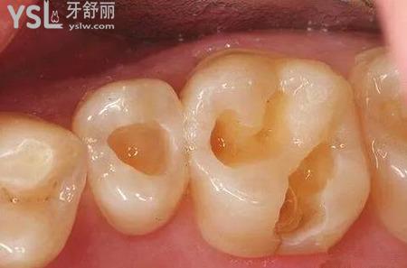 補(bǔ)牙為什么疼？