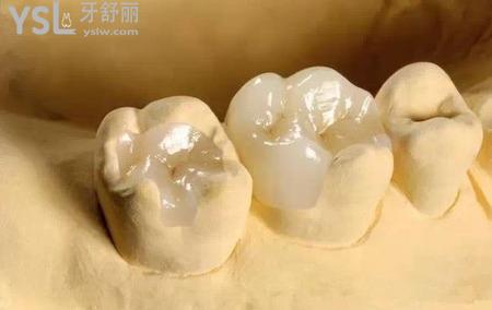 嵌體修復的優(yōu)勢是什么？