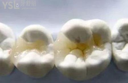 嵌體修復的禁忌癥是什么？