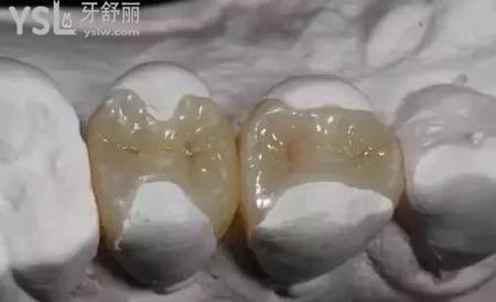 什么是牙齒嵌體修復？
