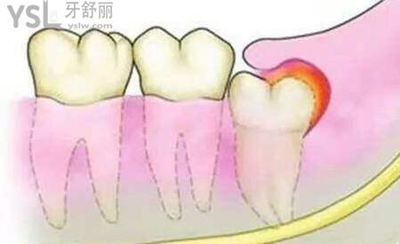 智齒長歪了一定要拔嗎？