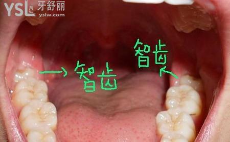 智齒不歪需要拔掉嗎？