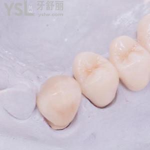 拉瓦全瓷牙一顆價(jià)格？