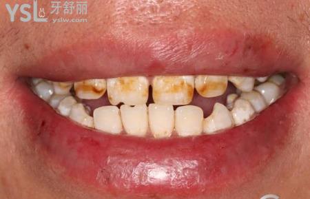 氟斑牙的特點(diǎn)是什么？