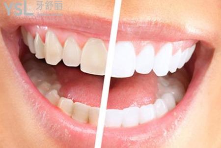 牙齒發(fā)黃怎么辦？