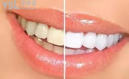 為什么每天刷牙牙齒還是很黃？