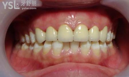 氟斑牙有什么注意事項(xiàng)？