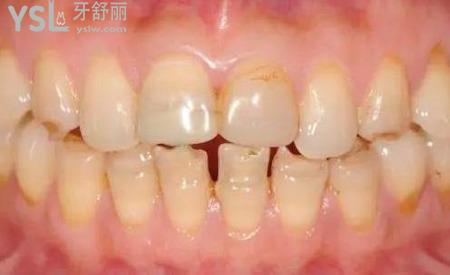 牙齒很黃怎么辦？