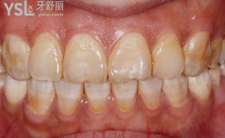 氟斑牙用小蘇打好嗎？