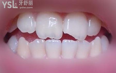 門(mén)牙磕掉一小塊怎么處理？