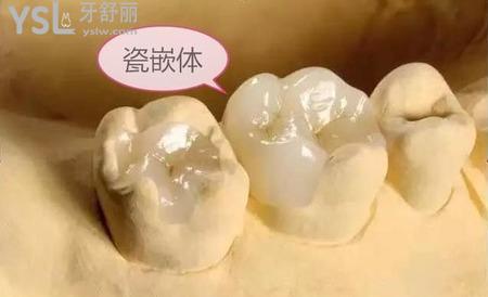 嵌體補(bǔ)牙后能用幾年？