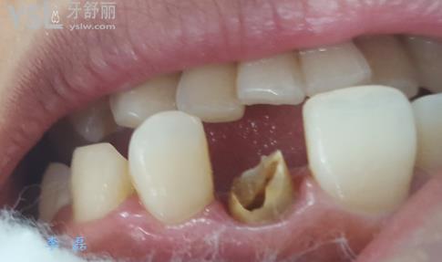 爛牙根十年了很臭怎么辦？