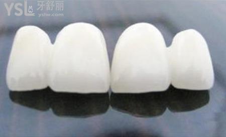 烤瓷牙可以洗牙嗎？