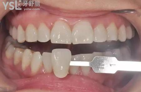 貼完牙貼牙齒酸睡不著怎么辦？